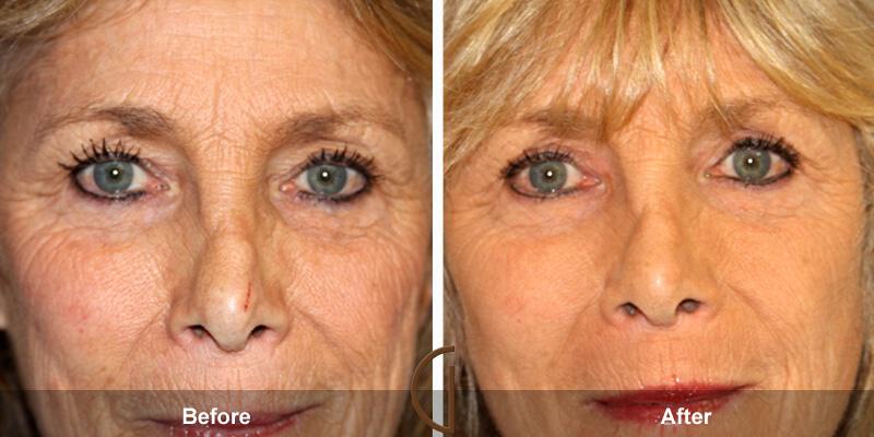 Eyelid Lift Before & After Photo