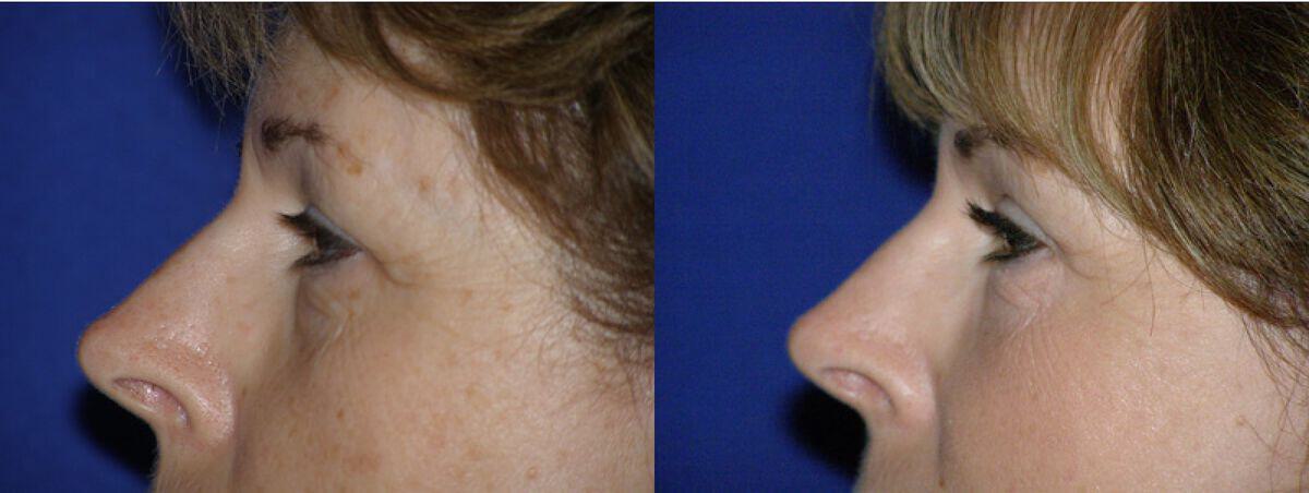 Eyelid Lift Before & After Photo