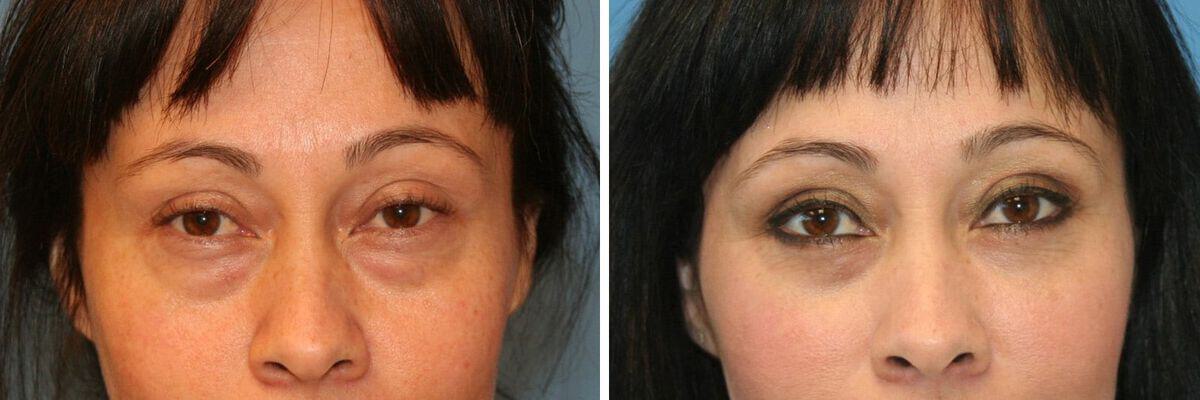 Eyelid Lift Before & After Photo