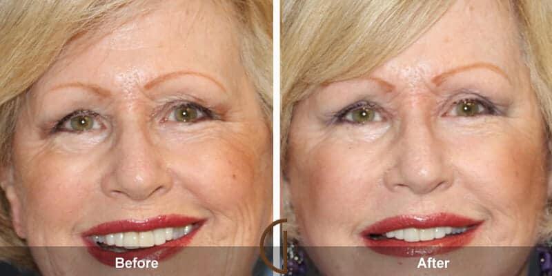 Eyelid Lift Before & After Photo