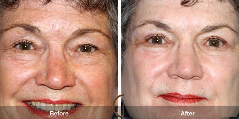 Eyelid Lift Before & After Photo