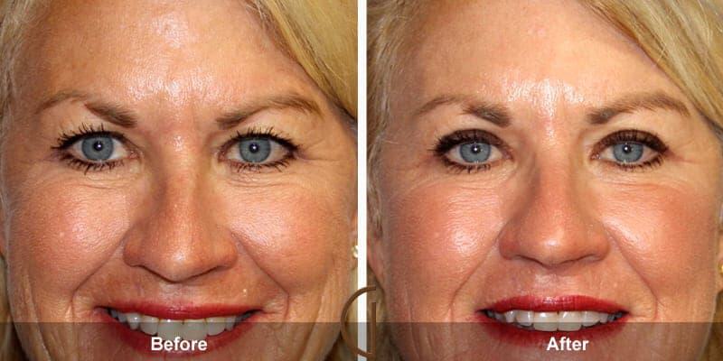 Eyelid Lift Before & After Photo