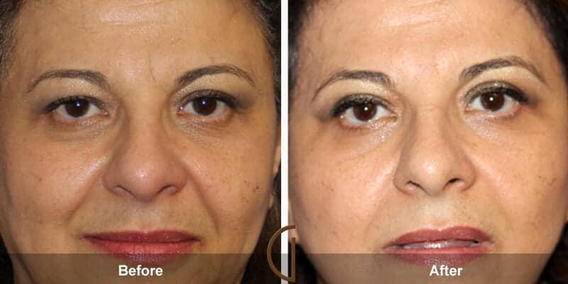 Eyelid Lift Before & After Photo