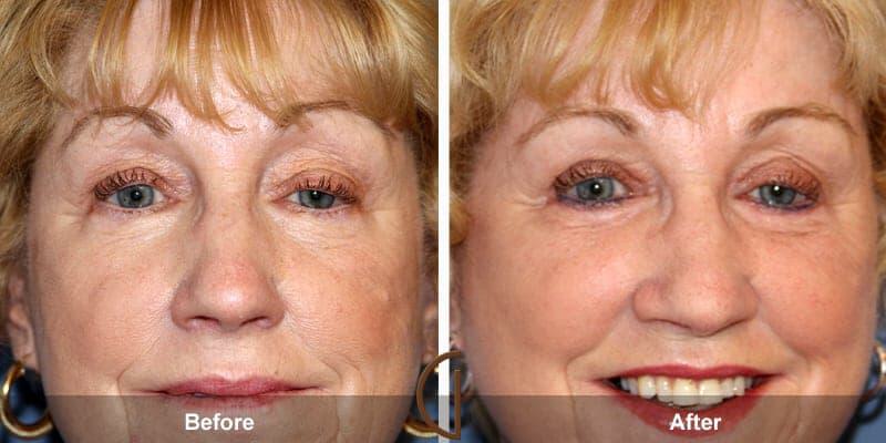 Eyelid Lift Before & After Photo