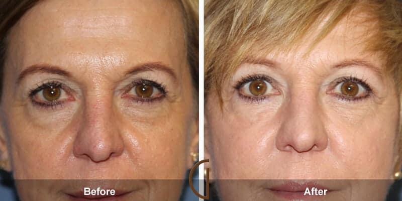 Eyelid Lift Before & After Photo