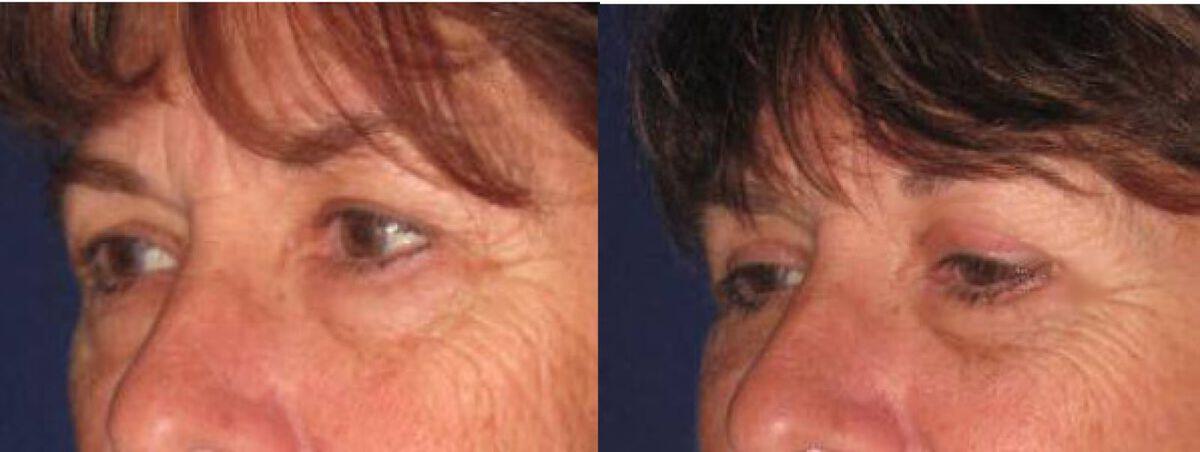 Eyelid Lift Before & After Photo