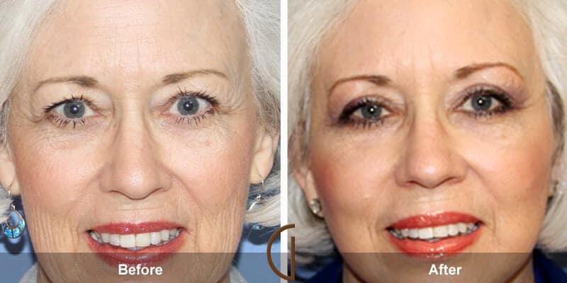 Eyelid Lift Before & After Photo