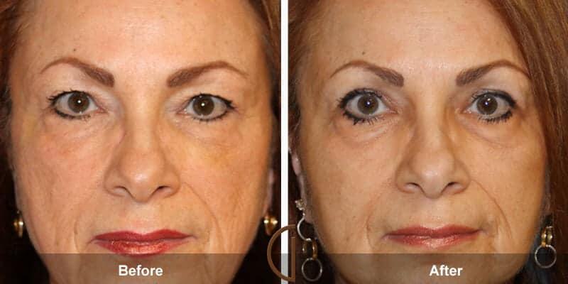 Eyelid Lift Before & After Photo