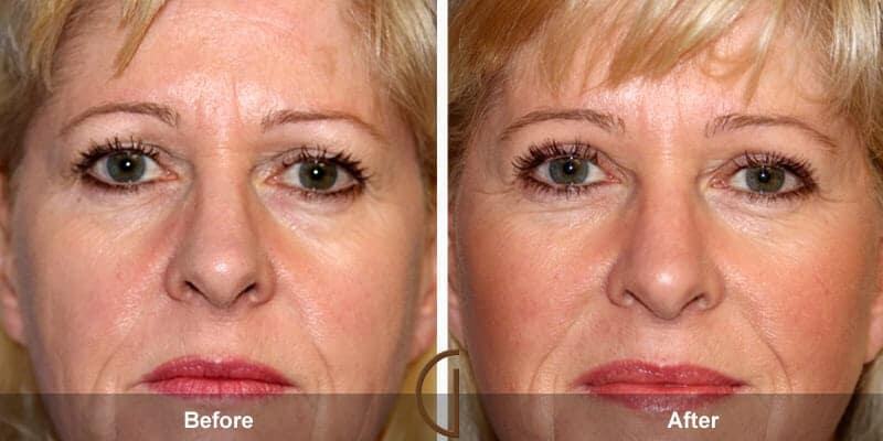 Eyelid Lift Before & After Photo