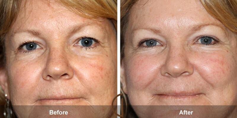 Eyelid Lift Before & After Photo