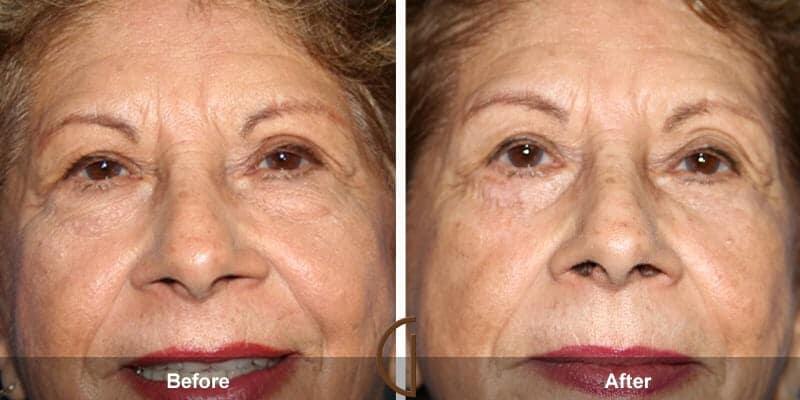 Eyelid Lift Before & After Photo