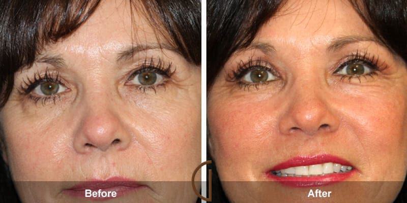 Eyelid Lift Before & After Photo