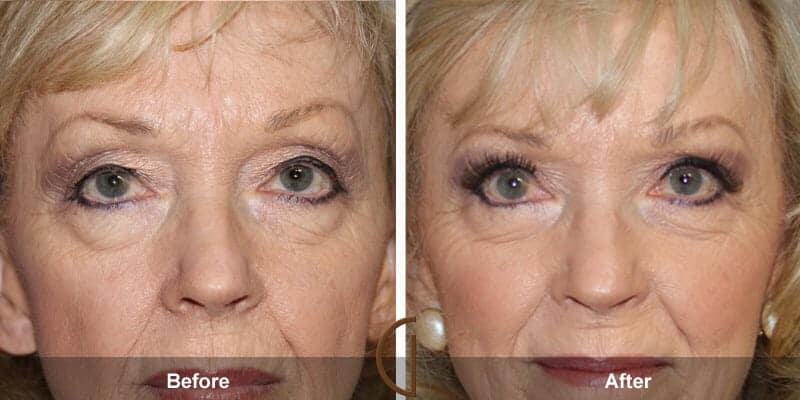 Eyelid Lift Before & After Photo