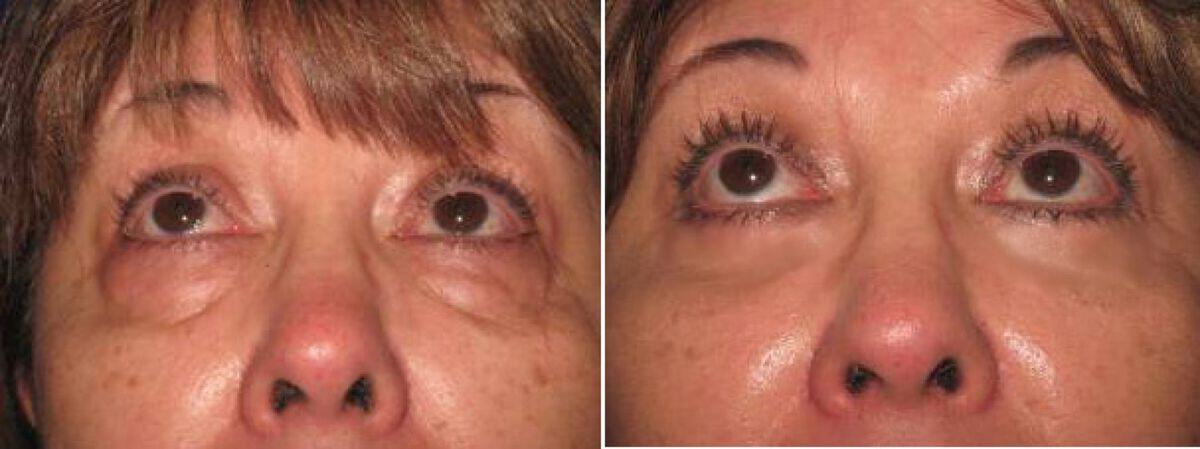 Eyelid Lift Before & After Photo