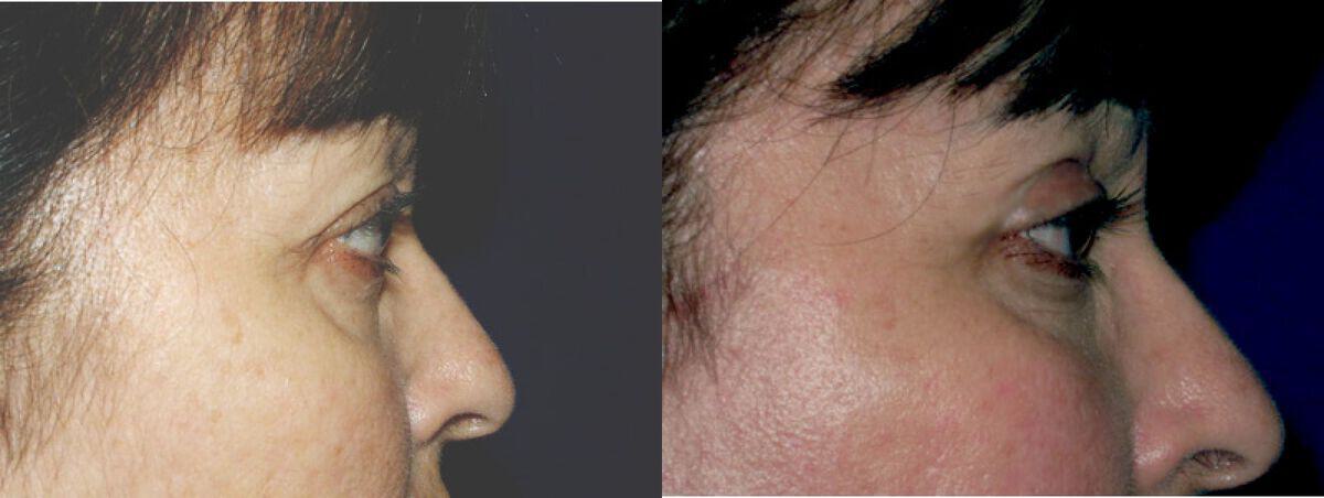 Eyelid Lift Before & After Photo