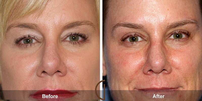 Eyelid Lift Before & After Photo