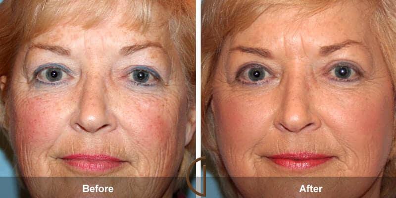 Eyelid Lift Before & After Photo