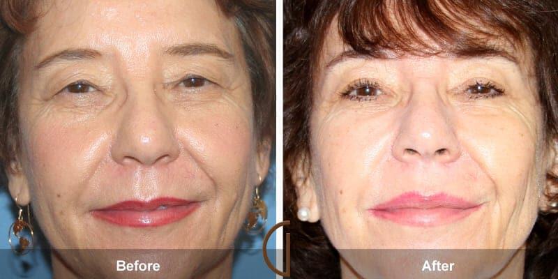 Eyelid Lift Before & After Photo