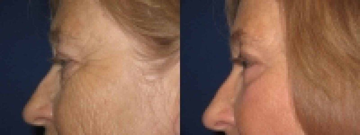 Eyelid Lift Before & After Photo