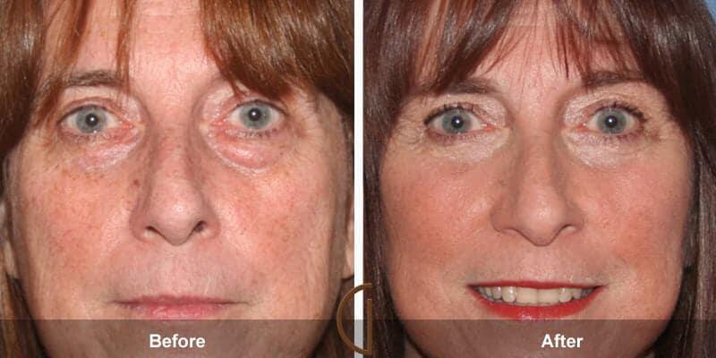 Eyelid Lift Before & After Photo