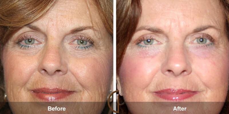 Eyelid Lift Before & After Photo