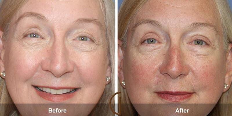 Eyelid Lift Before & After Photo