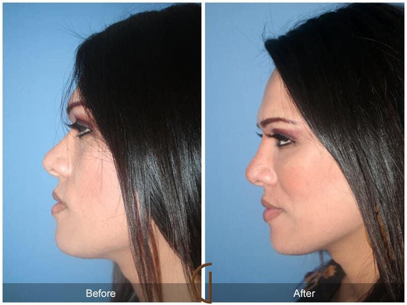 Facial Fat Grafting Before & After Photo