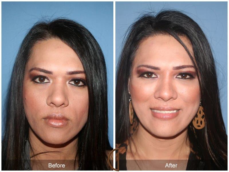 Facial Fat Grafting Before & After Photo