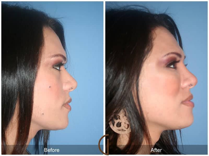 Facial Fat Grafting Before & After Photo