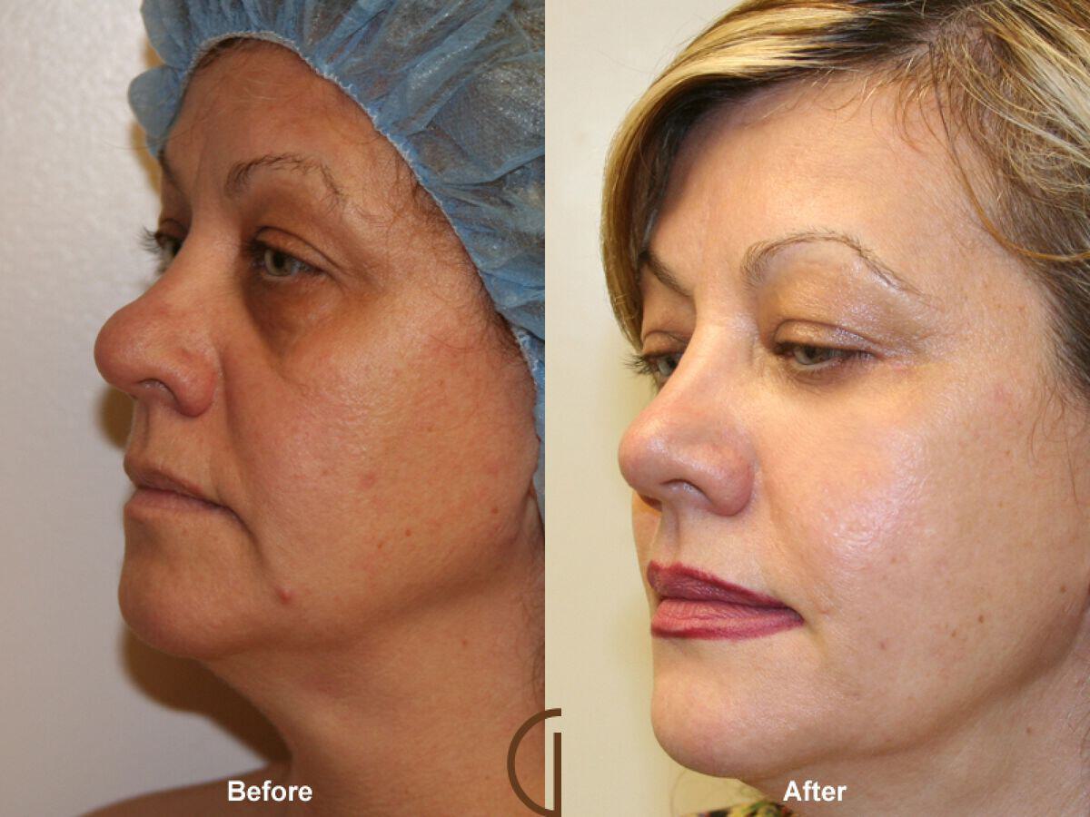 Facial Fat Grafting Before & After Photo