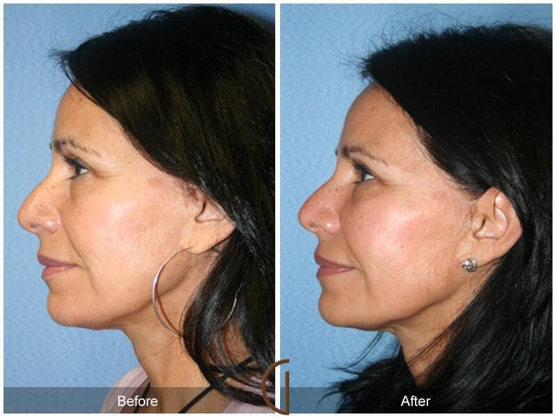 Facial Fat Grafting Before & After Photo