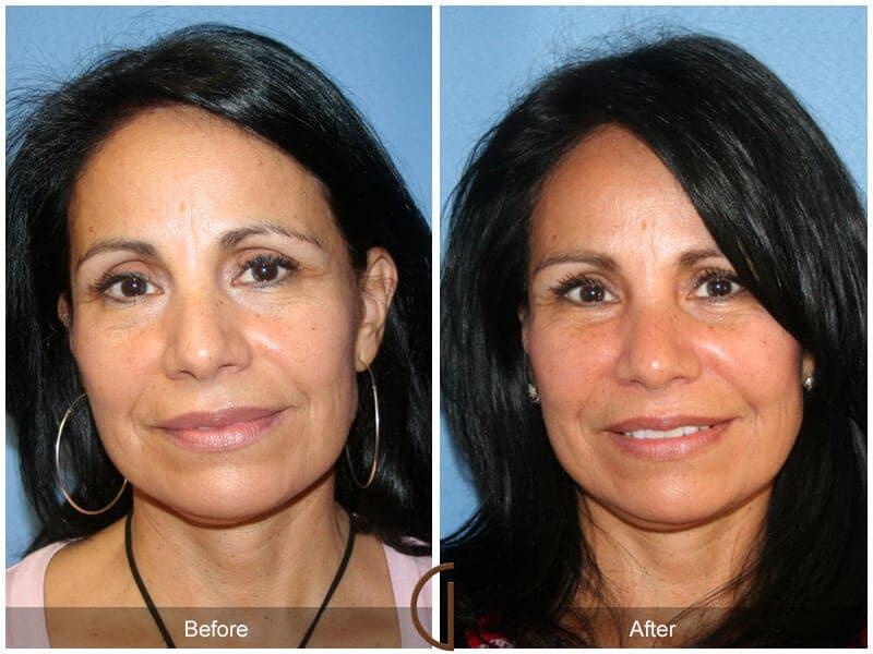 Facial Fat Grafting Before & After Photo