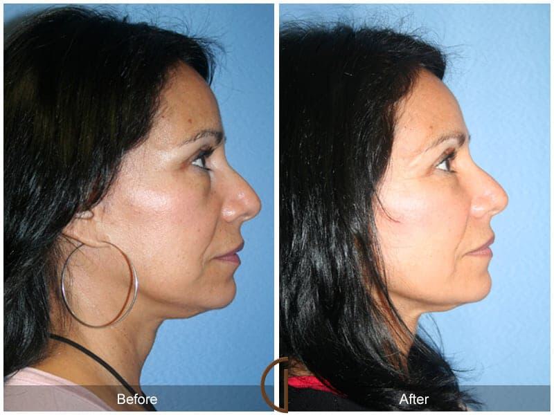 Facial Fat Grafting Before & After Photo