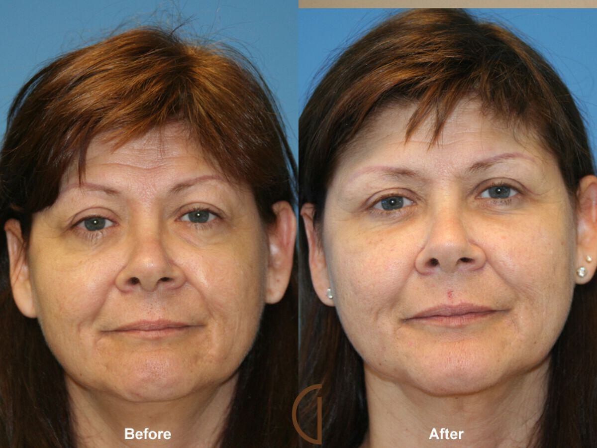 Facial Fat Grafting Before & After Photo