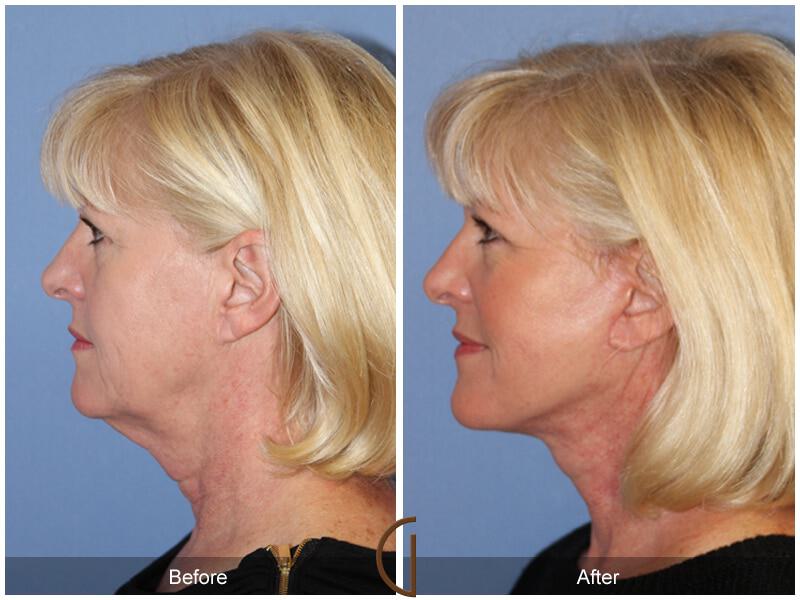 Facial Fat Grafting Before & After Photo