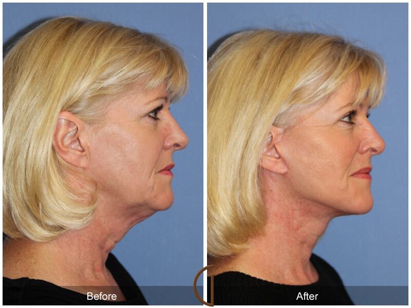 Facial Fat Grafting Before & After Photo