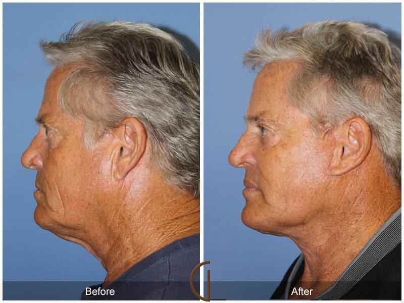 Facial Fat Grafting Before & After Photo