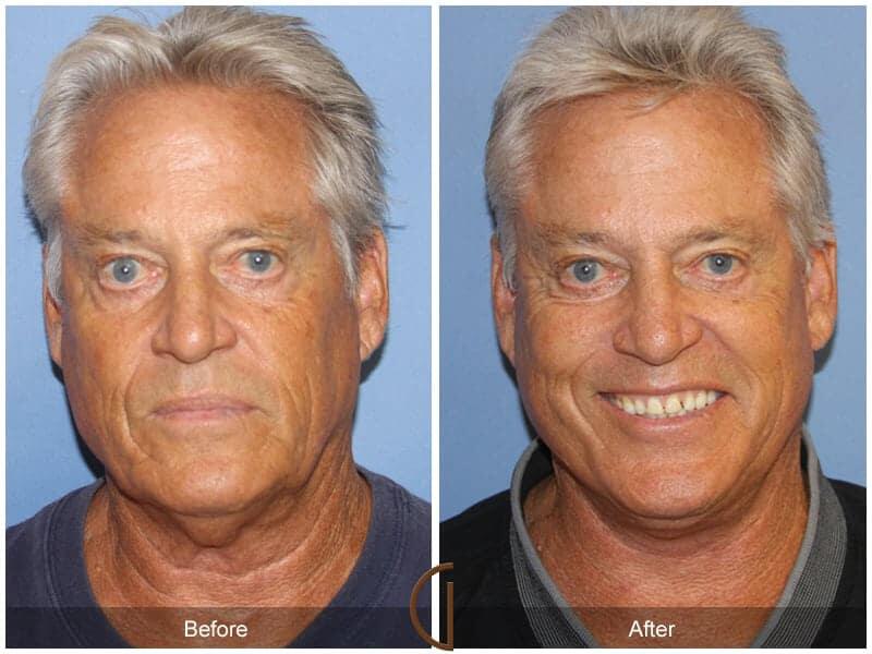 Facial Fat Grafting Before & After Photo