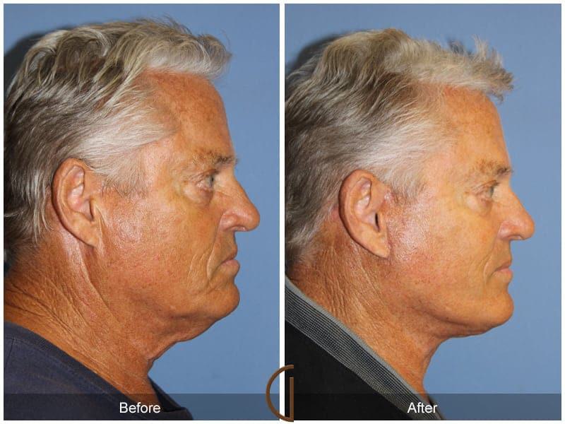 Facial Fat Grafting Before & After Photo