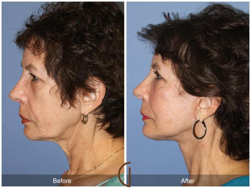 Facial Fat Grafting Before & After Photo