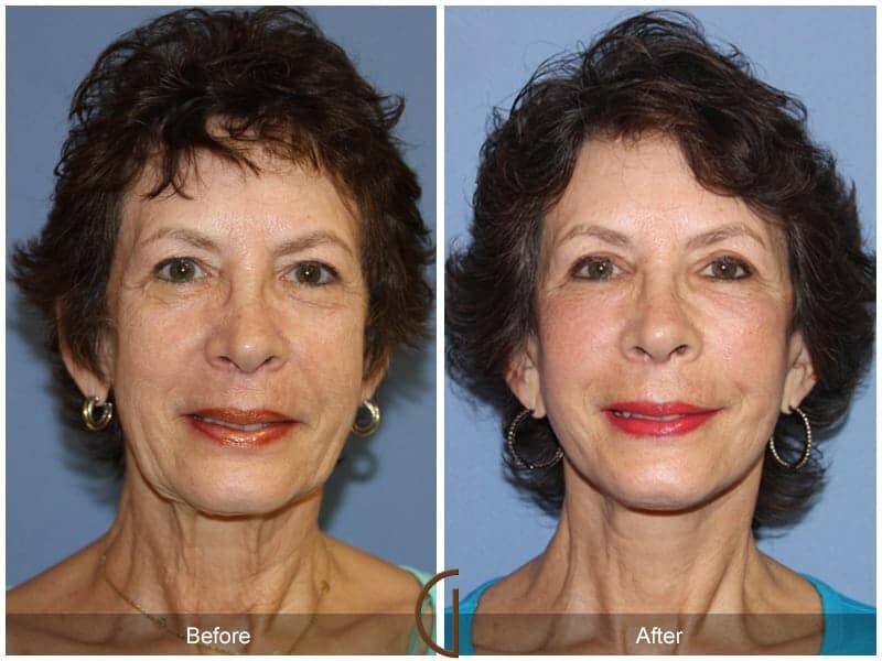 Facial Fat Grafting Before & After Photo