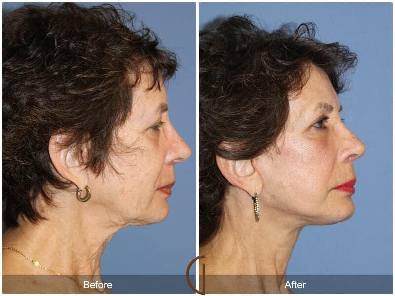 Facial Fat Grafting Before & After Photo