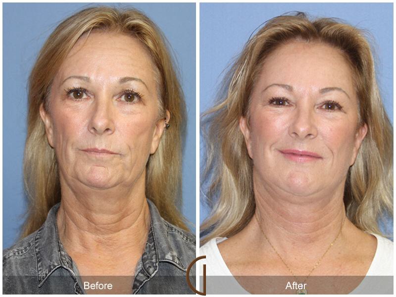 Facial Fat Grafting Before & After Photo