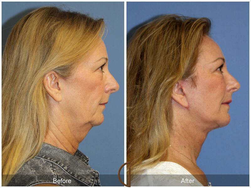 Facial Fat Grafting Before & After Photo