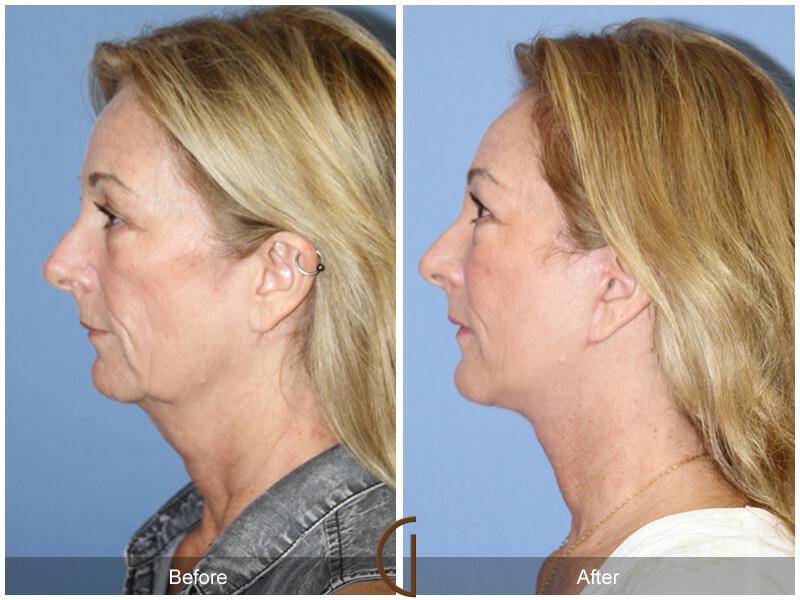 Facial Fat Grafting Before & After Photo