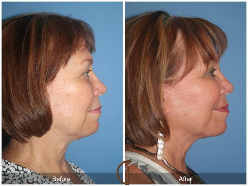 Facial Fat Grafting Before & After Photo