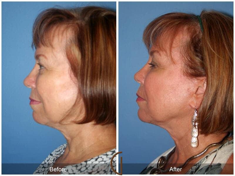 Facial Fat Grafting Before & After Photo