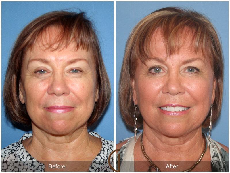 Facial Fat Grafting Before & After Photo