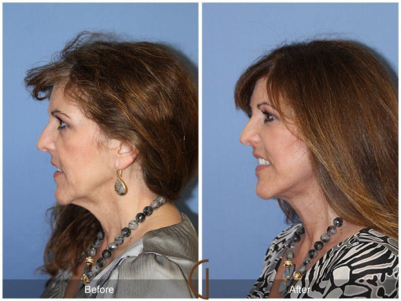 Facial Fat Grafting Before & After Photo