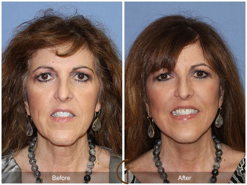 Facial Fat Grafting Before & After Photo